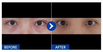 [カンナムオンニ] 目の下の脂肪再配置 / 1ヶ月目 / ニックネーム：ヤプシ