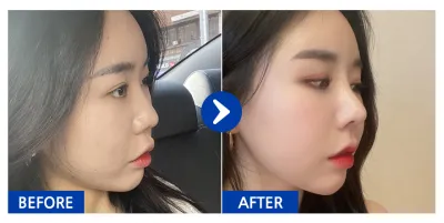 [カンナムオンニ] 鼻整形 / 1ヶ月目 / ニックネーム：ドルルルドルルル