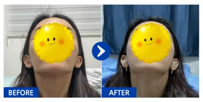 [バビトーク] 頬骨縮小 / 1ヶ月目 / ニックネーム：チイイイイキン