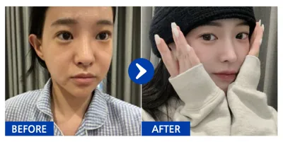 [カンナムオンニ] 鼻再手術 / 2ヶ月目 / ニックネーム：ハイルイクバ