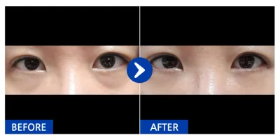 [カンナムオンニ] 目の下の脂肪再配置 / 1ヶ月目 / ニックネーム：ナエヨㄴ