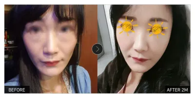 [カンナムオンニ 口コミ] フルフェイス脂肪移植＋目の下の脂肪再配置 2ヶ月目 / ニックネーム：ラビネ