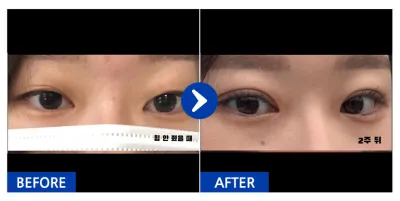 [カンナムオンニ] 自然癒着 / 1ヶ月目 / ニックネーム:easyn