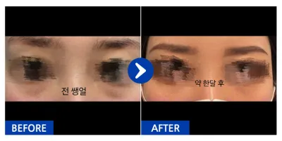 [カンナムオンニ] 目の下の脂肪再配置 / 1ヶ月目 / ニックネーム: ショロン