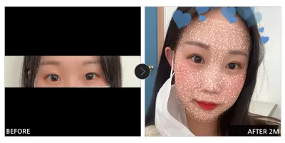 [カンナムオンニ 口コミ] 目の整形 1ヶ月目 / ニックネーム：コッシンシンジャ