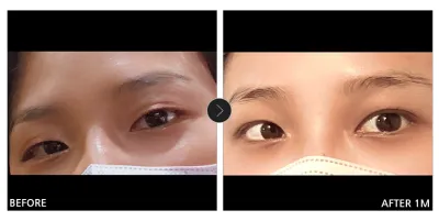 [カンナムオンニ 口コミ] 目の整形 1ヶ月目 / ニックネーム：疲れたアルマジロ