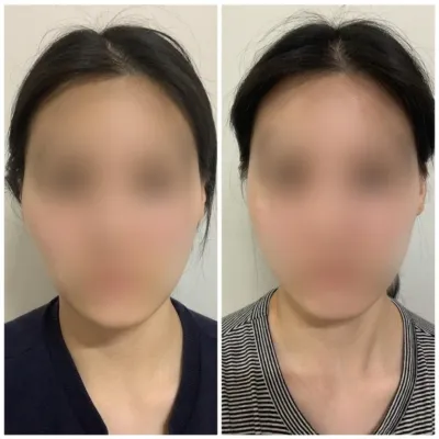 [カンナムオンニ 口コミ] 輪郭整形1ヶ月目 / ニックネーム：ドビメラ