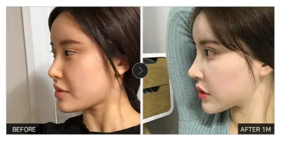 [カンナムオンニ 口コミ] 鼻整形1ヶ月目 / ニックネーム：2233332222