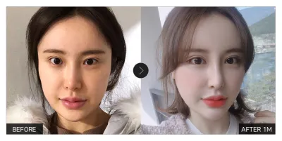 [カンナムオンニ レビュー] 目整形 1ヶ月目 / ニックネーム : 2233332222