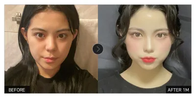 [カンナムオンニ レビュー] 顔の脂肪移植 1ヶ月目 / ニックネーム：タムゴンマインドゥ