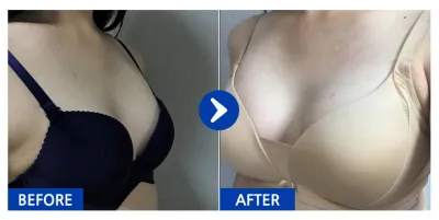 [カンナムオンニ] 豊胸整形(セビンマイクロテクスチャ) / 2ヶ月目 / ニックネーム：ジョンシュギ