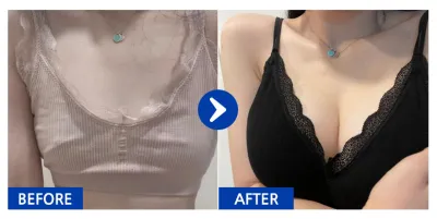 [カンナムオンニ] 豊胸整形(セビン) / 3ヶ月目 / ニックネーム：ヒョンニヒョンニ