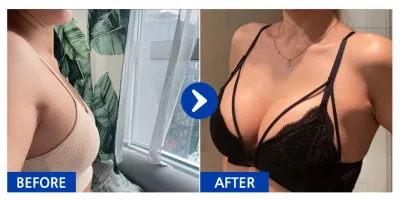 [カンナムオンニ] 豊胸整形(モティバ) / 5ヶ月目 / ニックネーム:Regina0