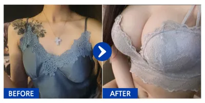 [カンナムオンニ] 豊胸整形(セビンマテック) / 9ヶ月目 / ニックネーム：コソンシルワヨン