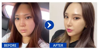 [カンナムオンニ] 鼻整形 / 5ヶ月目 / ニックネーム：黒真珠