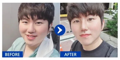 [カンナムオンニ] 鼻整形 / 5ヶ月目 / ニックネーム：ボンジュロナム