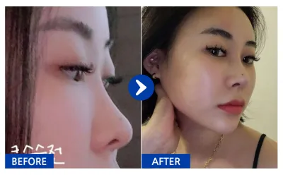 [バビトーク] 鼻整形 / 2ヶ月目 / ニックネーム：コッシュニ