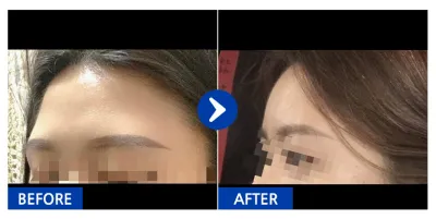 [カンナムオンニ] 脂肪移植 / 2ヶ月目 / ニックネーム：영ㅇ0