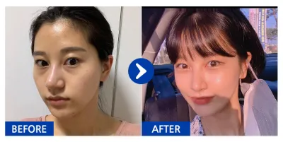 [バビトーク] 脂肪移植 / 5ヶ月目 / ニックネーム：アメリカルノ