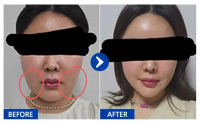 [カンナムオンニ] 脂肪吸引 / 2ヶ月目 / ニックネーム：コブギ様