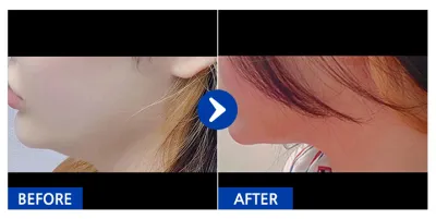 [カンナムオンニ] 脂肪吸引 / ニックネーム:BYJ72