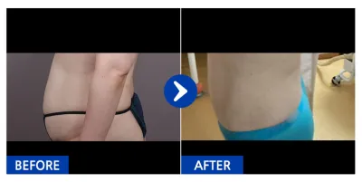 [バビトーク] 脂肪吸引 / 1ヶ月目 / ニックネーム：花のような者