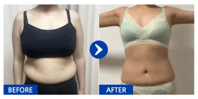 [バビトーク] 腹部・二の腕の脂肪吸引 / 5ヶ月目 / ニックネーム：食べないで知ってる味