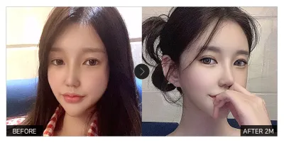 [カンナムオンニ 口コミ] 目つき矯正、目の再手術1ヶ月目 / ニックネーム：wingit