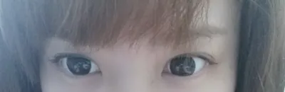 [目] ムービースター7 - 目尻切開、タレ目形成