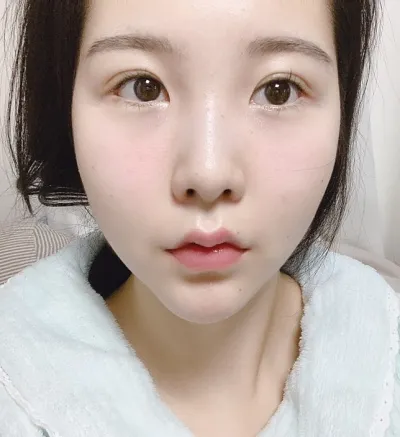 [目] 冬 - 切開二重(再手術), 目頭切開(再手術), 垂れ目形成