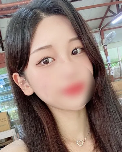 [目] トゥリガラス - 埋没法二重(再手術)、グラマラスライン形成（下眼瞼下制術）