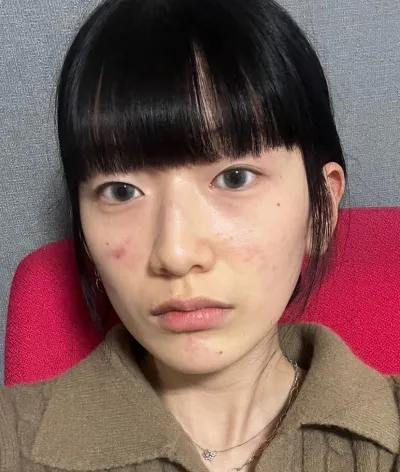 [目] イスル - 切らない眼瞼下垂手術