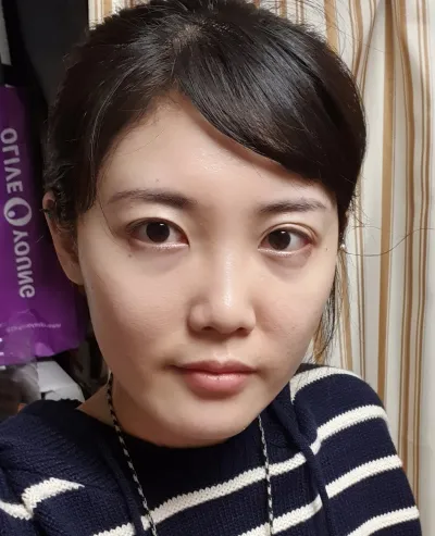 [目] ポジティブ - 切開二重再手術