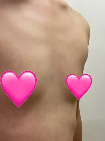 [豊胸] ネモビーム - 胸