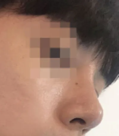 [鼻] コーズ802 - 鼻筋