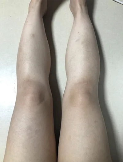 [脂肪吸引] zz0808 - 脂肪吸引