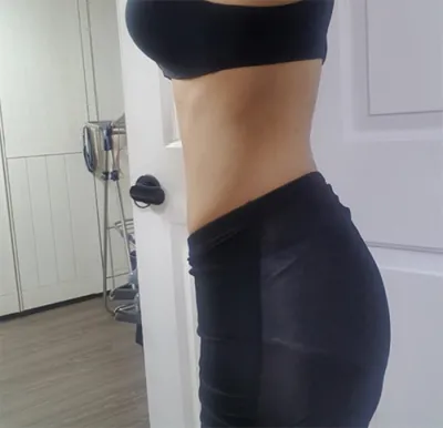 [脂肪吸引] ジュビダーム - 脂肪吸引(腹部)