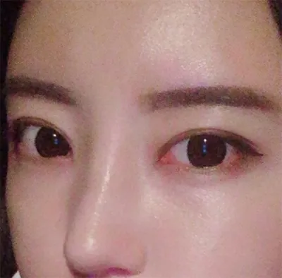 [鼻] tatun12 - 鼻、目、脂肪移植