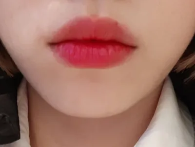 [プチ] ディアルーファ - フィラー、ボトックス