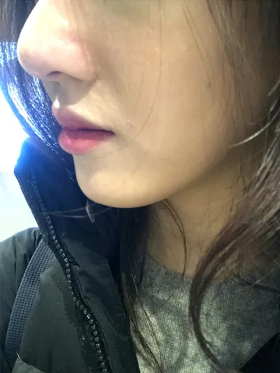 [プチ] si123 - 鼻の輪郭注射