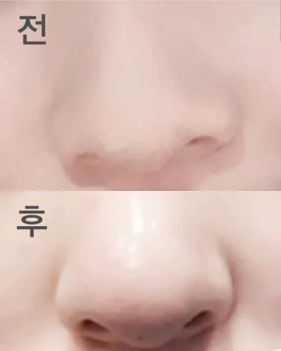 [プチ] プル - 鼻の輪郭注射