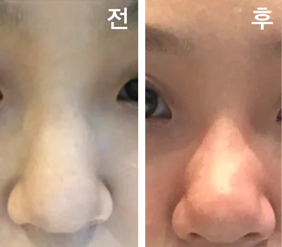 [쁘띠] 뀨잉3535 - 鼻の輪郭注射