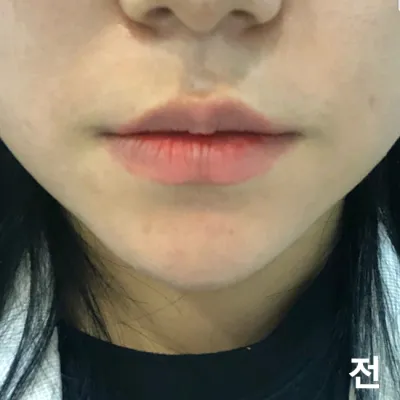 [プチ] トトルヤ - 唇フィラー、ボトックス