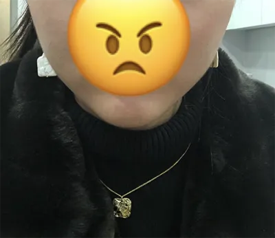 [プチ] ミンジ - ボトックス、顎先フィラー