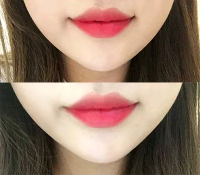 [プチ] amslam - 唇フィラー