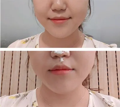 [皮膚] ドットヌリ - シルリフティング、シュリンク