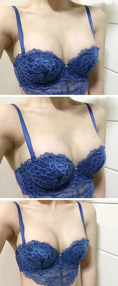 [豊胸] ekehae - 胸