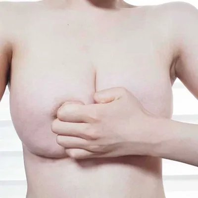 [豊胸] スイカのような胸 - 豊胸