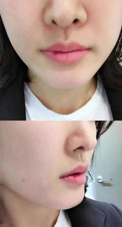 [プチ] ホンホンドド - 唇フィラー