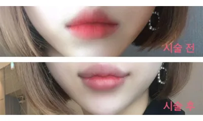 [プチ] きれいになろう - 唇フィラー